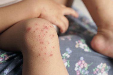 Çocuk 'un el ve ağız hastalığıyla enfekte olmuş dizine yakından bakın ya da enterovirüs kaynaklı HFMD ya da koxsackie virüsü, cildinde kırmızı sertlik. Görüntüyü yakınlaştır.