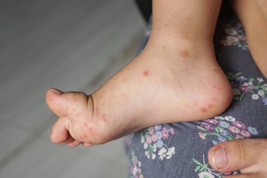 Close up view of child's feet infected with hand feet and mouth disease or HFMD originating from enterovirus or coxsackie virus, close up view zoom shot. clipart