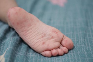 close up view of child's feet infected with hand feet and mouth disease or HFMD originating from enterovirus or coxsackie virus, zoom shot. clipart