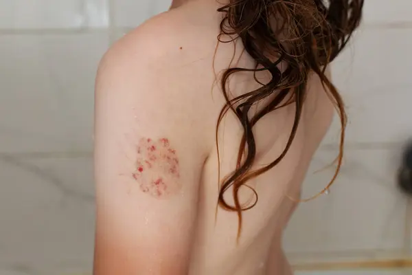 Kolunda hemanjiyom olan bir kız.