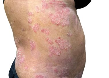 Sedef hastalığında mide. Çok ciddi lezyonlar. Ülser. Yaşlı, beyaz kadınlar. Deri hastalıkları. - Evet. Yüksek kalite fotoğraf