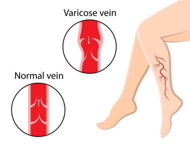 Varisli damarlar. Bacak ağrısı. İnsan Anatomisi. Vektör illüstrasyonu