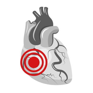 Enfarktüs. Beyaz bir arka planda kalp ağrısı. Vektör illüstrasyonu