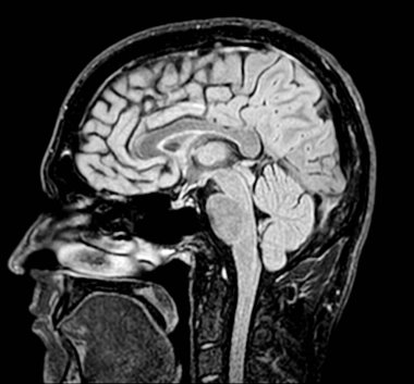 Beyin MR taramasının Sagittal görüntüsü. Bu tıbbi görüntüleme nöroloji ve radyolojide teşhis ve analiz için gerekli bilgileri sağlayarak beyin yapılarını vurgular.