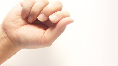 Kuru ve çatlamış tırnaklı eller.