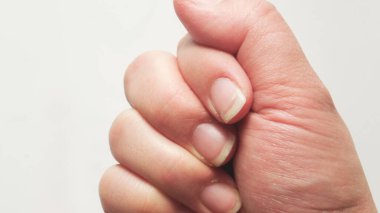 Kuru ve çatlamış tırnaklı eller.