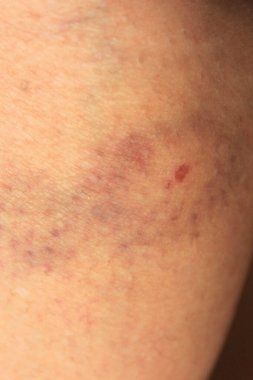 Küçük köpek ısırığı, çürük, bacak yarası.