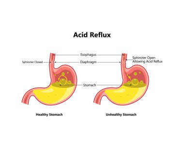 Reflü ya da gastroözofajiyal reflü, mide yanması. Mide hastalığı, mide hastalığı konsepti. Vektör çizimi