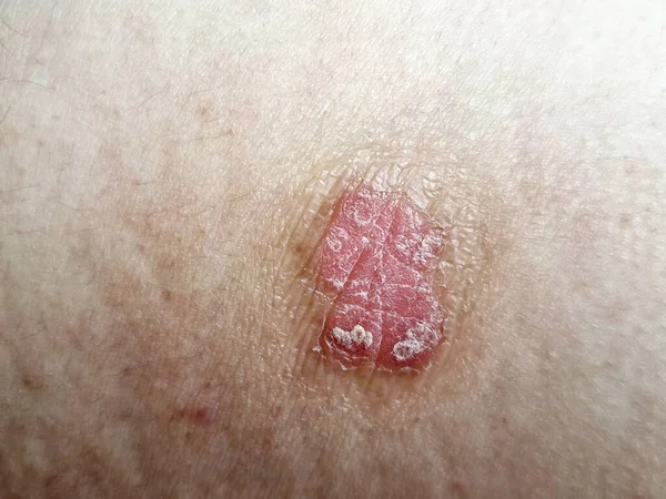 An example of seborrhoeic dermatitis on the skin is a long-term skin disorder