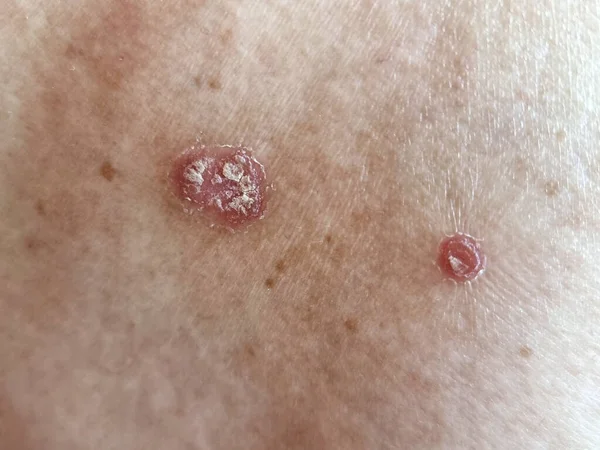 An example of seborrhoeic dermatitis on the skin is a long-term skin disorder
