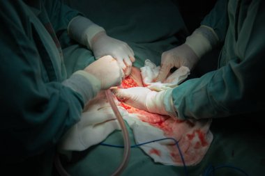 Hastanede sezaryen doğum prosedürü