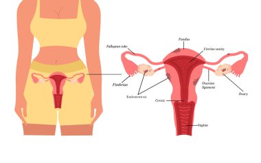 Endometriosis Sick female reproductive system Painful menstruation concept. clipart