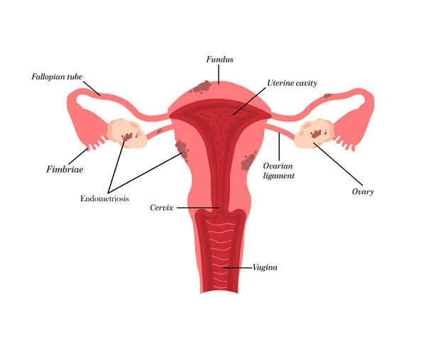 Anatomia Útero Endometriose Estrutura Dos Órgãos Pélvicos Ginecologia — Vetor de Stock