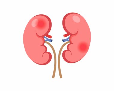 İnsan Vücut Sağlığı ve Tıp Konseptinde Yetersiz Beslenme nedeniyle kronik böbrek hastalığından muzdarip.