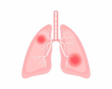 Göğüs ağrısı. Akciğerlerde ağrı. Vücut akciğerleri..