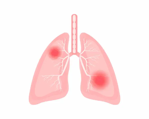Dyskomfort Klatce Piersiowej Ból Płuc Anatomia Płuc Organizmie Człowieka — Wektor stockowy