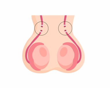 Erkek sterilizasyon prosedürleri vasektomi ve tüp bağlama sağlık hizmetleri ve doğum kontrol vektörü çizimi.