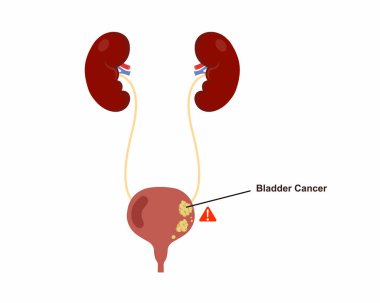 İdrar kesesi kanserli insan mesanesi anatomi vektörü çizimi.