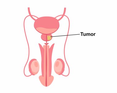 Erkek üreme sistemi onkolojisinde tümör. İnsan iç organı, prostat bezi, mesane anatomisi vektör çizimi.