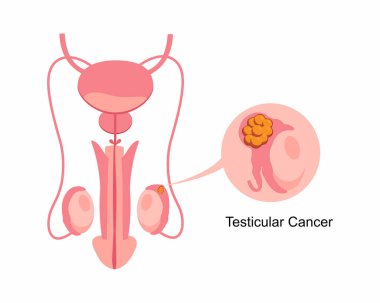 Testis kanseri erkek üreme sistemi hastalığı, onkoloji teşhisi Testis anatomisi insan vücudunda cinsel organ