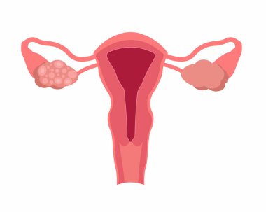 Kadınların Polisistik Yumurtalık Sendromu Kadın Üreme Sistemi Hastalığı Çizimi