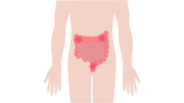 İnsan bağırsağı ağrısı hazımsızlık kabızlığı ve bakteri tıbbi animasyonu nedeniyle tıkanır.