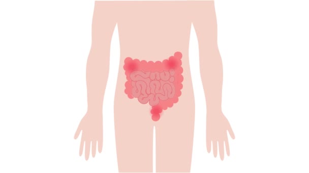 Dor Intestino Corpo Humano Enche Devido Indigestão Constipação Bactérias Animação — Vídeo de Stock