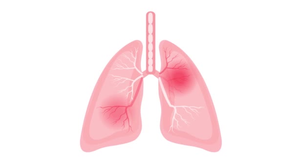 Dor Nos Pulmões Bronquite Ciência Médica Animação — Vídeo de Stock