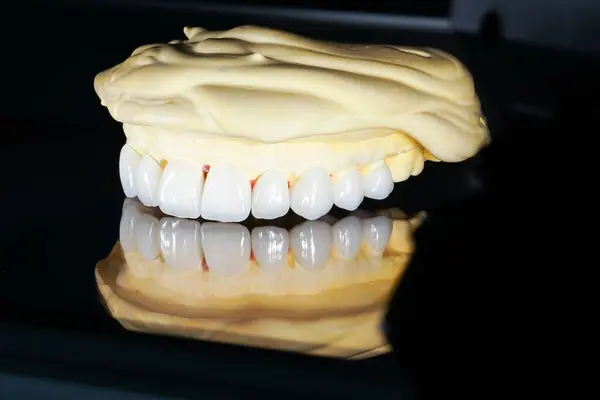 Veneers Presented False Jaw Isolated — Stock Photo, Image