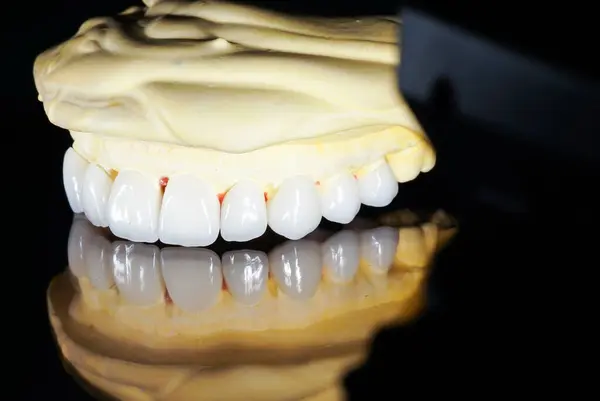 Veneers Presented False Jaw Isolated — Stock Photo, Image