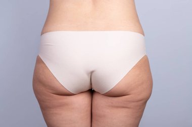 Biraz kilolu, selülitli ve cildinde gerilme izleri olan bir kadının kalçalarına yakından bakın. Kadın kavramı, selülit, aşırı kilo ve diyet