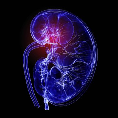 Humen kidney with injury x-ray film on a dark blue background clipart