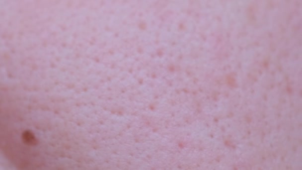男性の顔に問題の皮膚のマクロショットビデオ 人間の皮膚の毛穴 皮膚科治療 — ストック動画