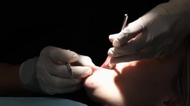 Magnified image of a young womans dental treatment process. In the dental chair. Implantology. Filling of teeth