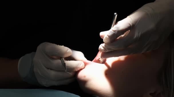 Magnified Image Young Womans Dental Treatment Process Dental Chair Implantology — Vídeo de stock