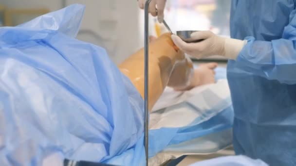 静脉血管外科诊所手术室的一位静脉注射学家对静脉曲张的腿进行了手术 现代创新的外科技术 — 图库视频影像