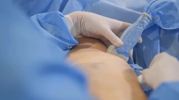 臨床医の外科医とアシスタントは 近代的で革新的なレーザーアブレーション法を使用して 静脈瘤の足で手術を行います 4Kビデオ — ストック動画