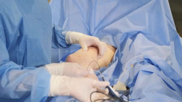 Operacja Chirurgiczna Żył Nóg Ablacja Endozylna Skleroterapia Także Podwiązanie Usunięcie — Wideo stockowe