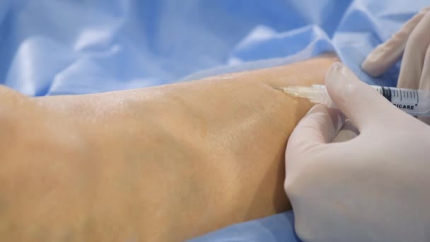 Χειρουργός Εκτελεί Μια Επέμβαση Στα Πόδια Κιρσούς Χρησιμοποιώντας Μια Σύγχρονη — Αρχείο Βίντεο