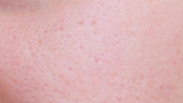 Big Pores Close Girl Has Skin Problems Oily Skin Whiteheads — Stock Video