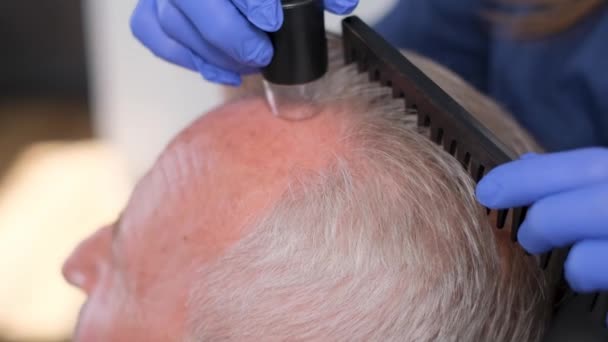 Zbliżenie Trychologa Badającego Starszego Mężczyznę Problem Łysienia Wypadania Włosów — Wideo stockowe