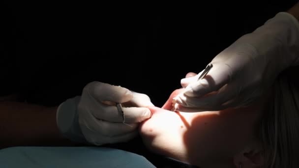 Διαδικασία Της Θεραπείας Των Δοντιών Των Ασθενών Ένα Φακό Στέμμα — Αρχείο Βίντεο