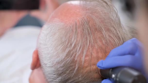 Пожилой Человек Проходит Обследование Трихолога Проблема Выпадения Волос Старости — стоковое видео
