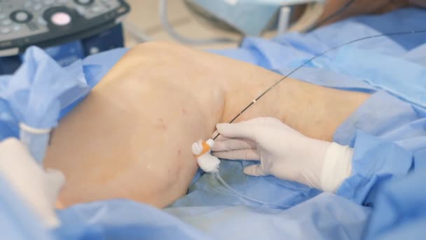外科医は 静脈瘤を有する高齢女性の足で動作します 外科医の作業プロセス バーティカルビデオ — ストック動画