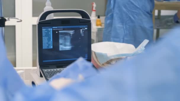 用现代监测器监测心脏外科手术中身体的重要功能 外科手术期间的医疗监测 — 图库视频影像