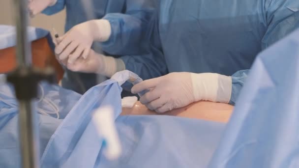 Process Performing Operation Group Professional Doctors Surgeon Performs Complex Operation — Vídeo de Stock