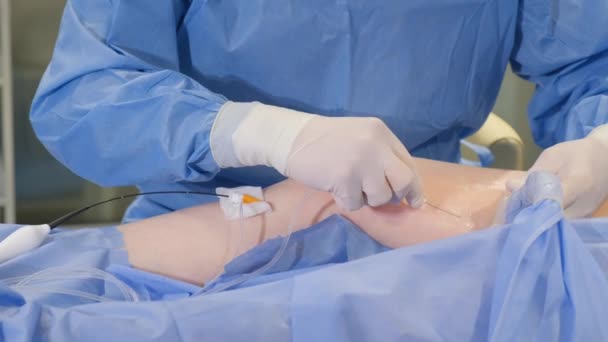Surgeon Operation Varicose Veins Legs Surgical Treatment Varicose Veins — Vídeo de Stock