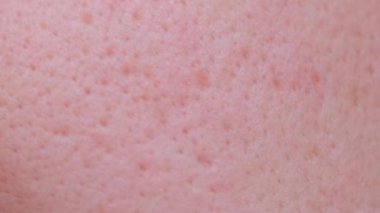 Extremely close-up technology of problem skin of a person with large own pores, acne scars. Macro photo of big pore on oily facial skin type.