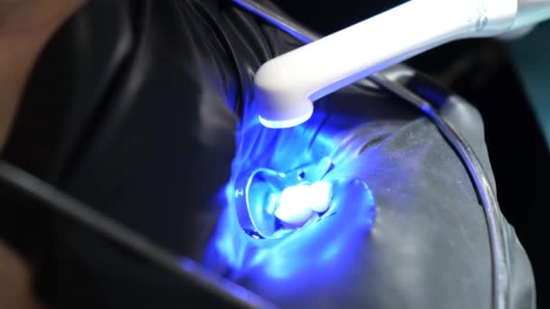 充填のための紫外線を使用して歯科治療のプロセスのクローズアップ 健康な歯の概念 近代的な歯科技術 — ストック動画