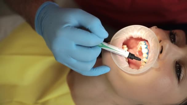 Tandarts Voert Het Bleken Van Tanden Met Behulp Van Moderne — Stockvideo